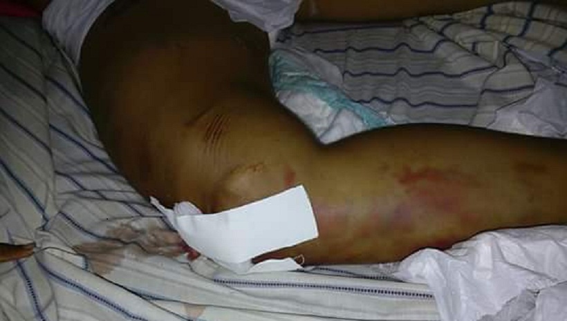 Fratura na perna da vitima -Foto mostra gravidade do ferimento.