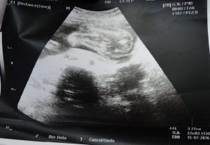 Imagem mostra idade do feto.