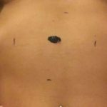 PIC FROM CATERS NEWS - (PICTURED A COLLECT OF THE MOLE) - A stunning woman is thanking bikini selfies for saving her life after she spotted a deadly mole. Cloe Jordan, 21, from Wolverhampton, West Mids, was diagnosed with an aggressive form of skin cancer - Melanoma - three months ago. Like most young women her age, Cloe was body conscious and was fed up of the mole on her stomach getting in the way of her pretty bikinis and underwear. So she decided to speak to her doctor about the mole, which was in the middle of her stomach, to see if it could be removed. Despite the mole growing in size and changing colour she had dismissed these worrying signs and after visiting her doctor, she was referred for further tests. SEE CATERS COPY