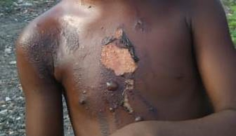 Uma das crianças ficava encarregada de cozinhar e estava com marcas de queimadura de óleo quente pelo corpo. — Foto: Polícia Civil / Pará 