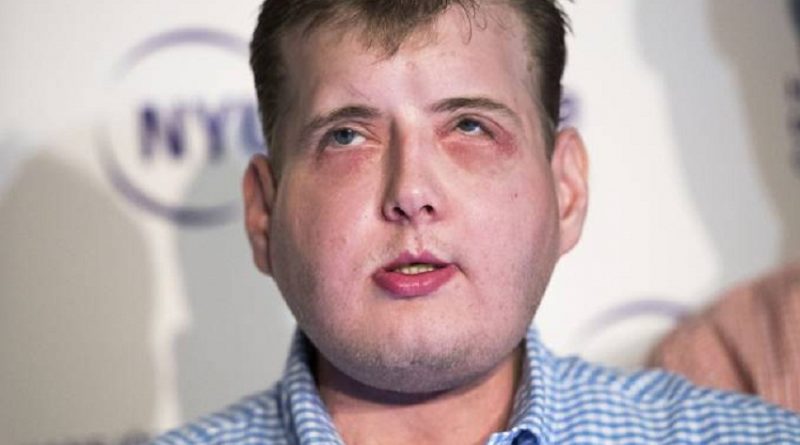 saucc81de-patrick-hardison-tansplante-rosto