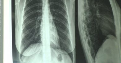 raio_-_x_tuberculose