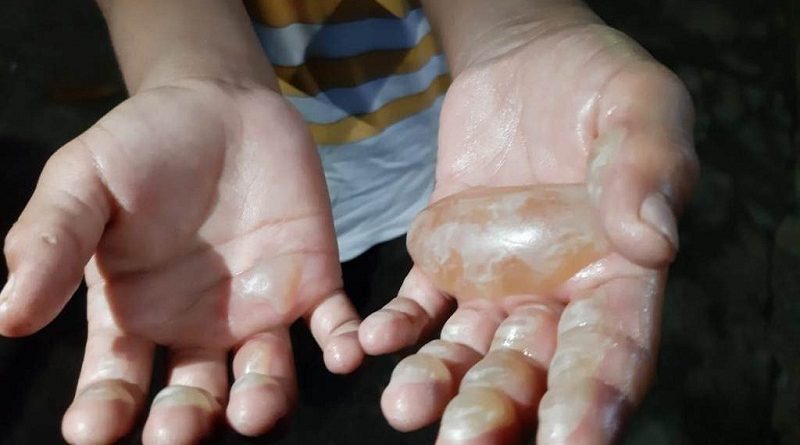 criança-mãos-queimadas-Foto-Jucélio-Paiva-1024x710