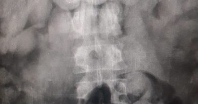 Exames apontam drogas dentro de corpo de suspeitos de tráfico internacional de drogas em Belém. — Foto: Reprodução / Assessoria Polícia Federal