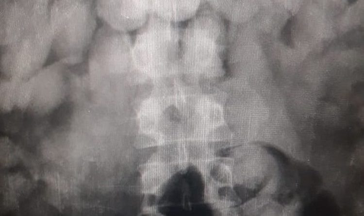 Exames apontam drogas dentro de corpo de suspeitos de tráfico internacional de drogas em Belém. — Foto: Reprodução / Assessoria Polícia Federal