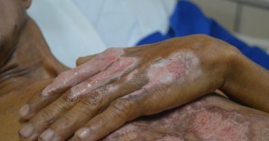 As marcas do acidente no corpo do mestre de obras, Uilton Oliveira. Foto Comunicação Pró-Saúde.