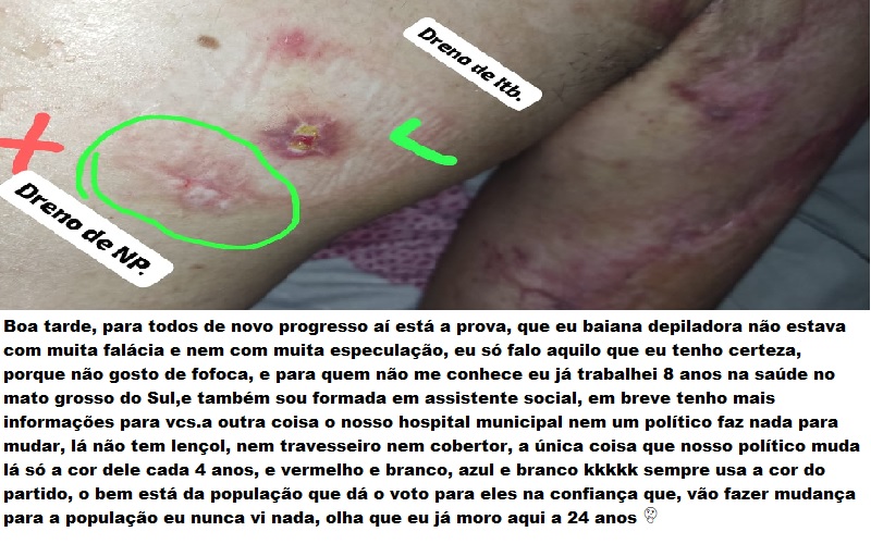 dreno paciente