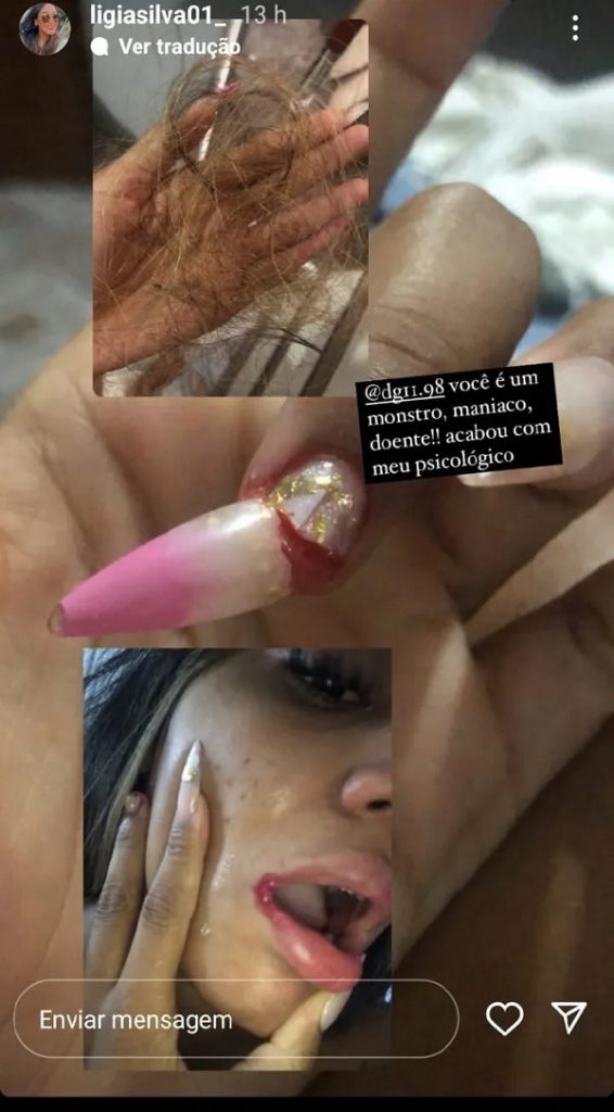 📷 Vítima relatou que teve o cabelo e unhas arrancados, além de ferimentos nos lábios |Reprodução 