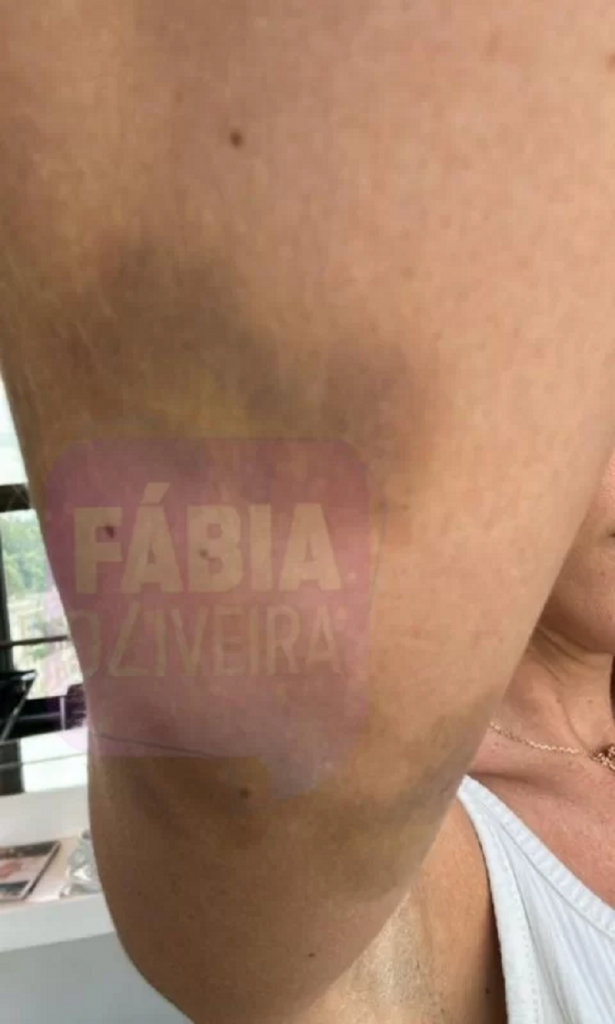 Cortes e hematomas: veja fotos de Maria Melilo após agressões do ex    Cortes e hematomas: veja fotos de Maria Melilo após agressões do ex    Cortes e hematomas: veja fotos de Maria Melilo após agressões do ex