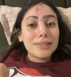 Jovem precisou fazer enxertos  de pele na testa  para reconstruir o nariz | Foto: Reprodução/Redes sociais