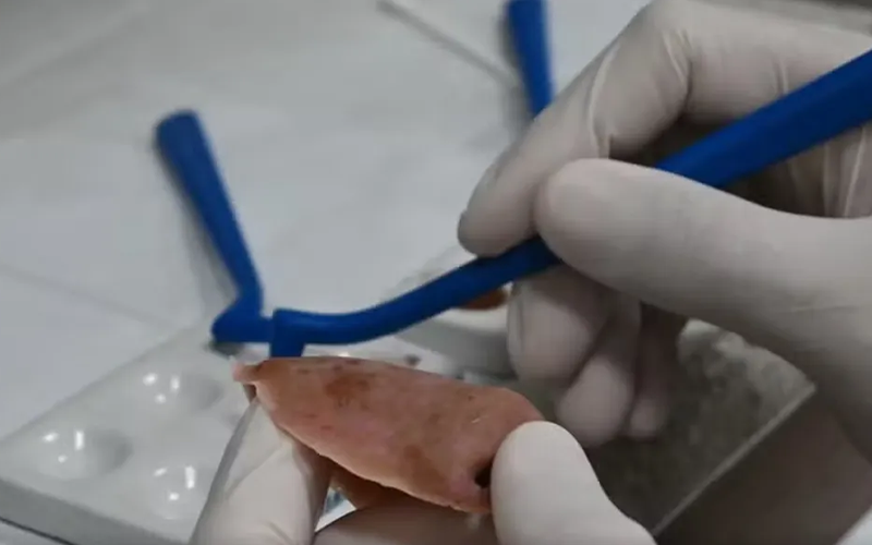 Ronaldo, portador de xeroderma pigmentoso, já passou por 230 cirurgias. Conheça sua história e a luta por qualidade de vida. | (Instituto Mais Identidade/Divulgação)