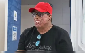 Ronaldo, portador de xeroderma pigmentoso, já passou por 230 cirurgias. Conheça sua história e a luta por qualidade de vida. | (Instituto Mais Identidade/Divulgação)