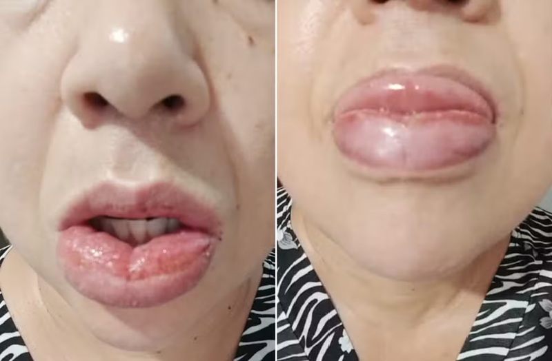 Educadora social, de 45 anos, sofre reação alérgica após uso de pasta de dente, em Miracatu (SP) — Foto: Arquivo pessoal