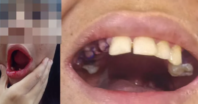 dentes arrancados (1)