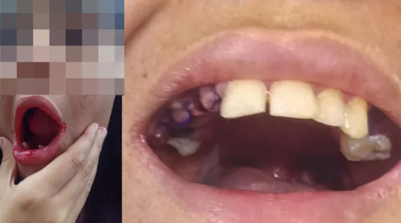 dentes arrancados (1)