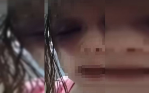 criança-agredida-com-vários-hematomcriança-agredida-com-vários-hematomas-as-