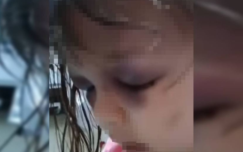 criança-agredida-com-vários-hematomas-