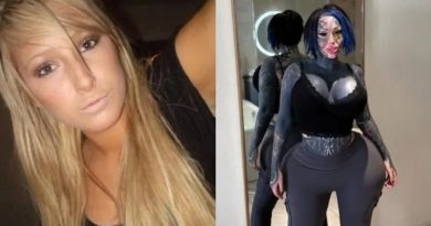 Modelo gastou R$ 2,6 milhões em cirurgias; veja antes e depois